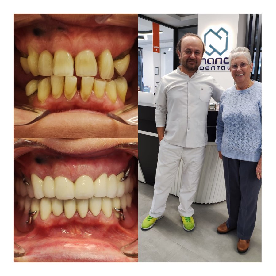 نانو الأسنان - Nano Dental