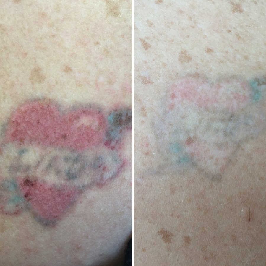 No Regrets Laser Tattoo Removal - No Regrets Laser Tattoo Removal