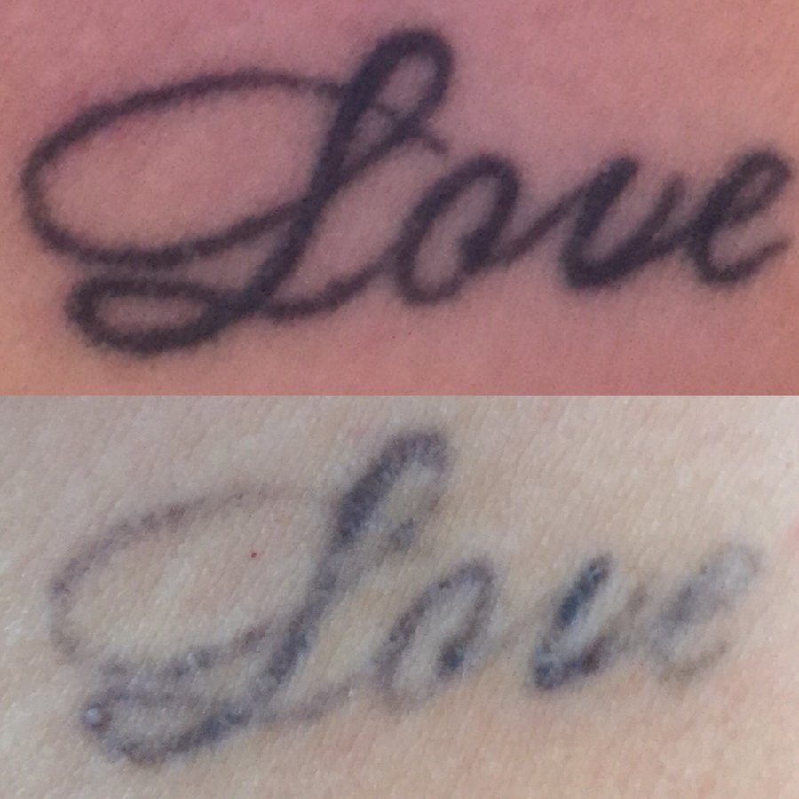No Regrets Laser Tattoo Removal - No Regrets Laser Tattoo Removal