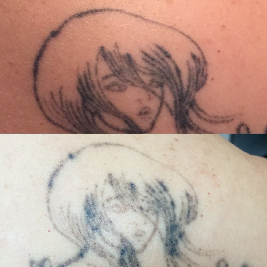 No Regrets Laser Tattoo Removal - No Regrets Laser Tattoo Removal