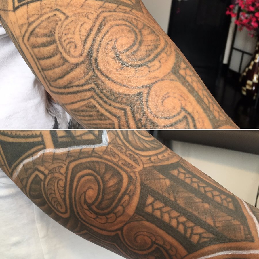 No Regrets Laser Tattoo Removal - No Regrets Laser Tattoo Removal