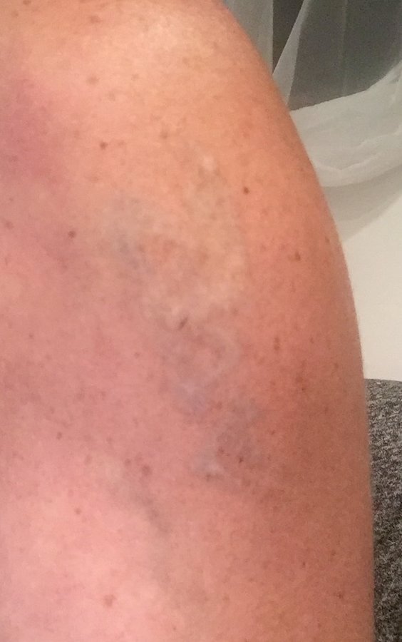 No Regrets Laser Tattoo Removal - No Regrets Laser Tattoo Removal