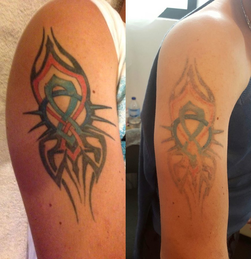 No Regrets Laser Tattoo Removal - No Regrets Laser Tattoo Removal