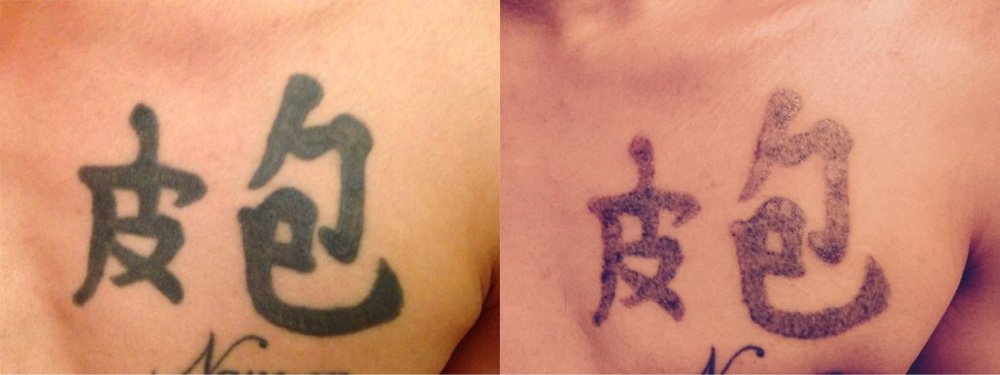 No Regrets Laser Tattoo Removal - No Regrets Laser Tattoo Removal