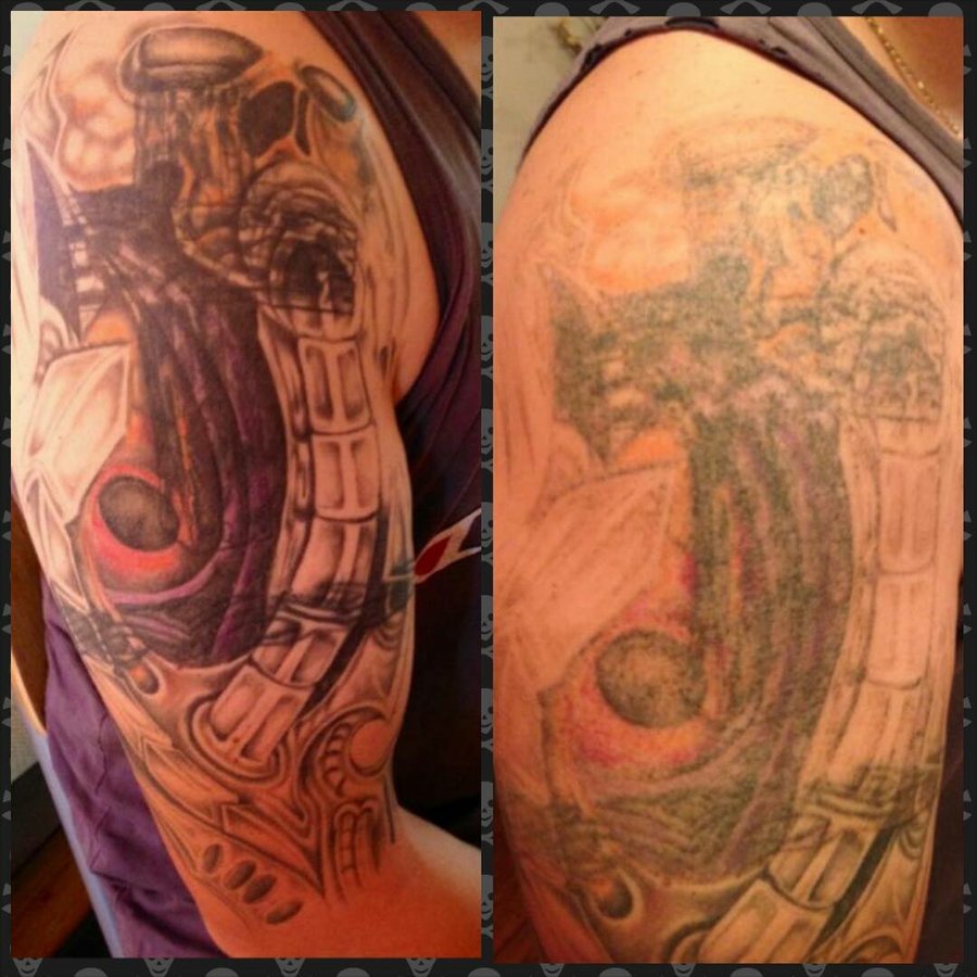 No Regrets Laser Tattoo Removal - No Regrets Laser Tattoo Removal