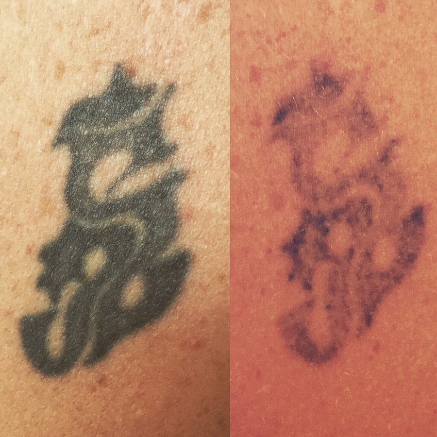 No Regrets Laser Tattoo Removal - No Regrets Laser Tattoo Removal