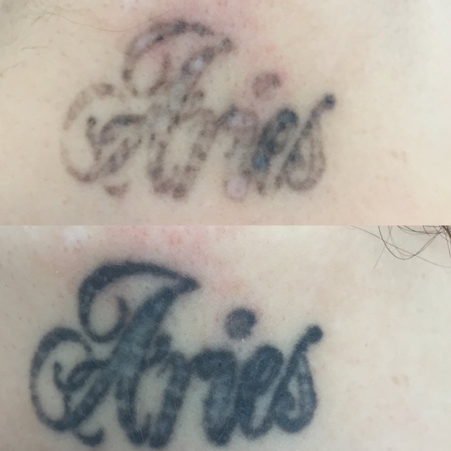 No Regrets Laser Tattoo Removal - No Regrets Laser Tattoo Removal