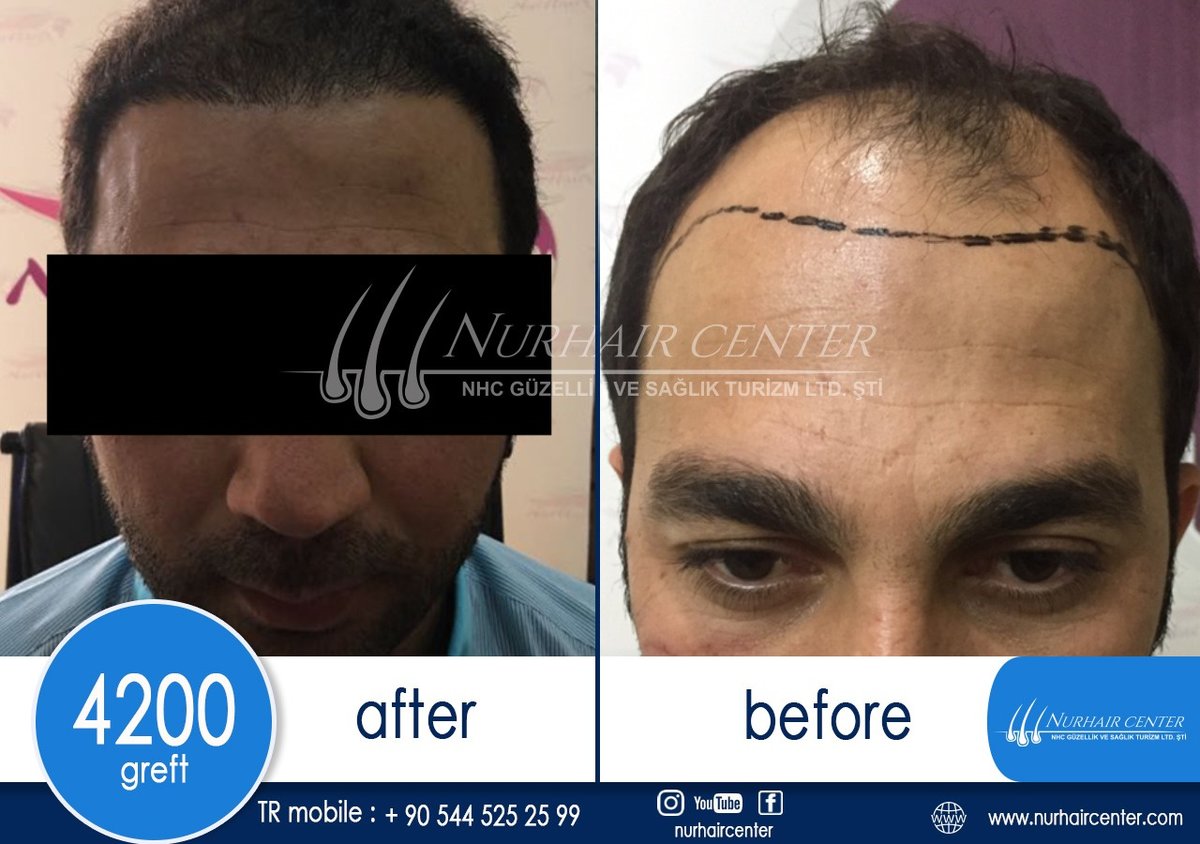 Nur Hair Center - Nur Hair Center