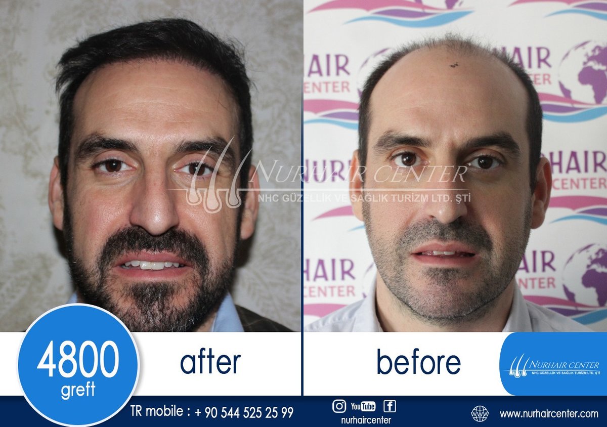 Nur Hair Center - Nur Hair Center