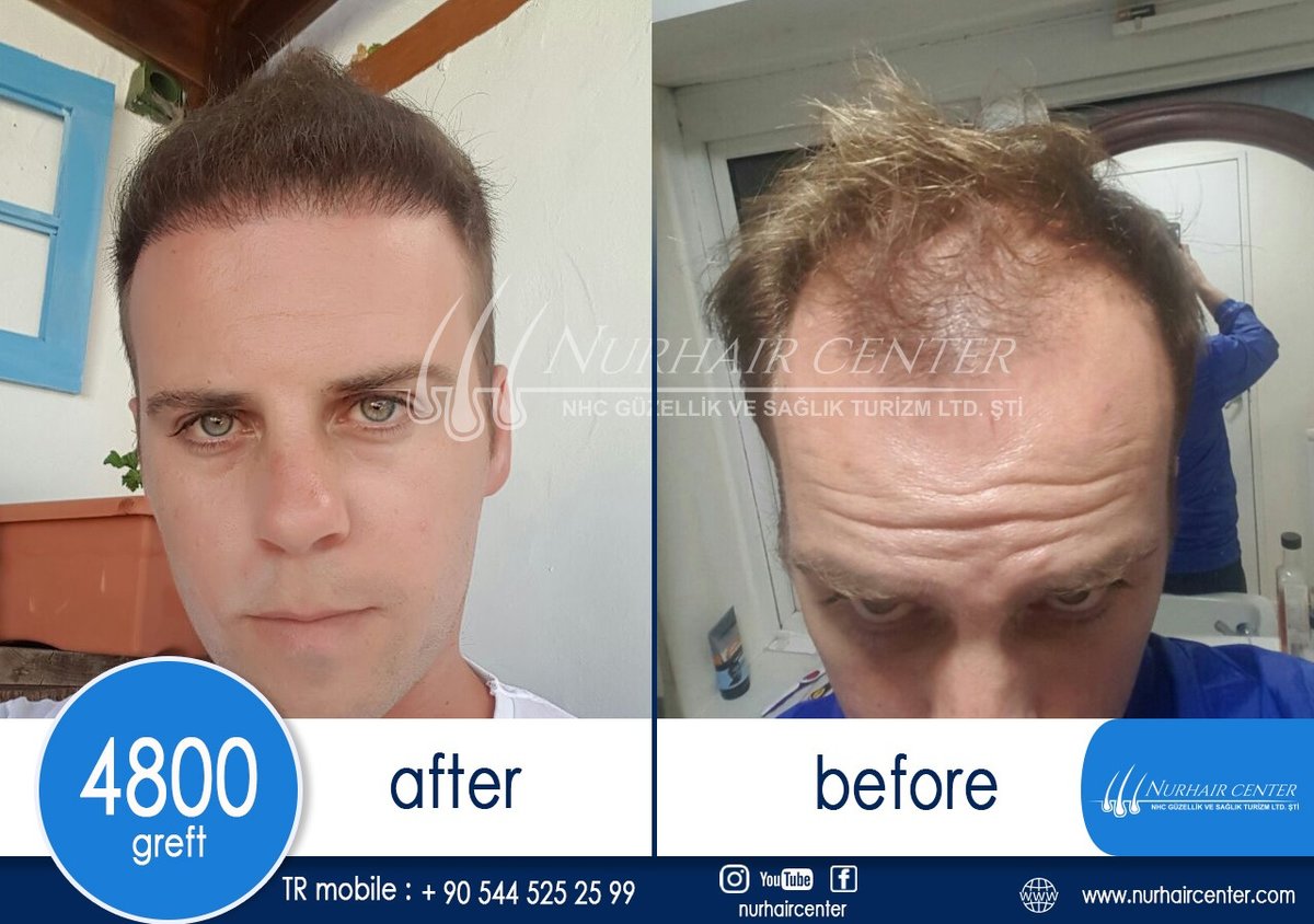 Nur Hair Center - Nur Hair Center