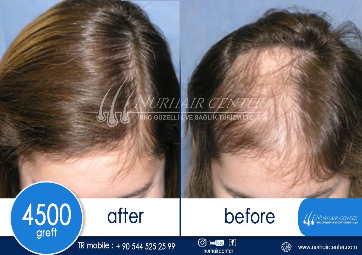 Nur Hair Center - Nur Hair Center