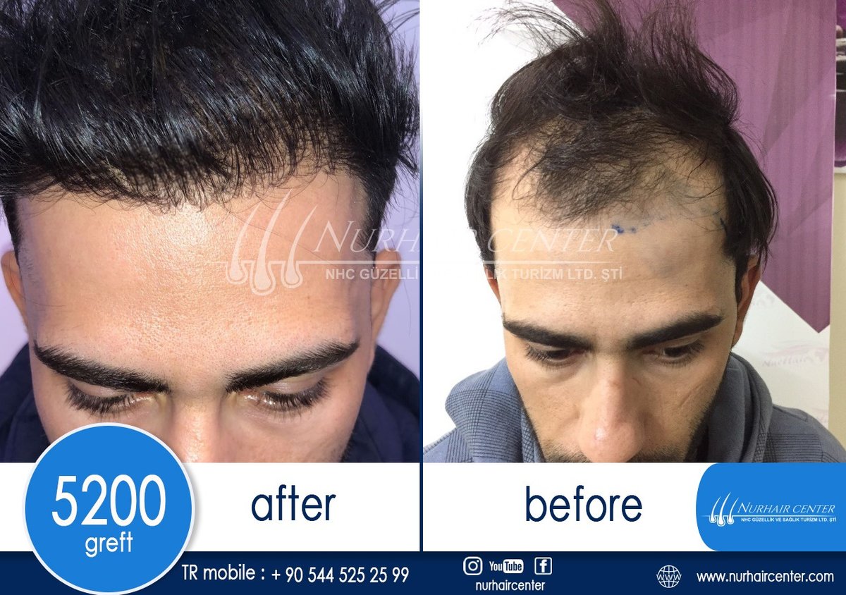 Nur Hair Center - Nur Hair Center
