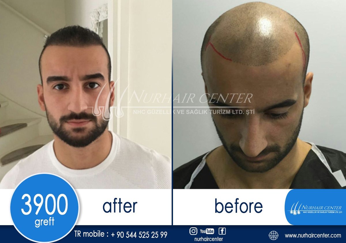 Nur Hair Center - Nur Hair Center