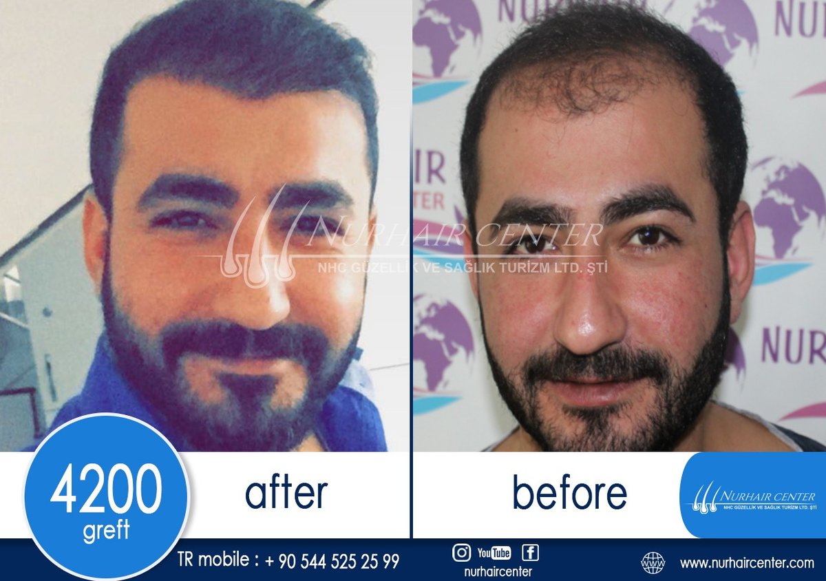 Nur Hair Center - Nur Hair Center