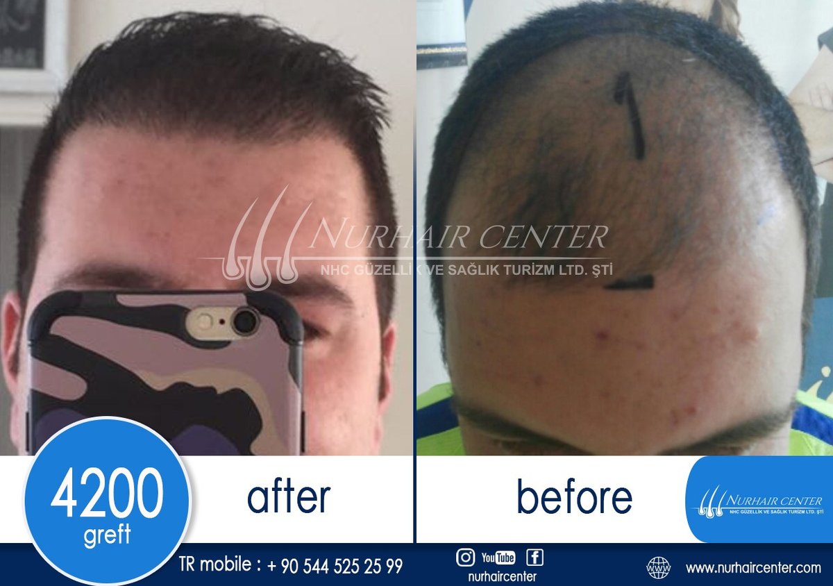 Nur Hair Center - Nur Hair Center