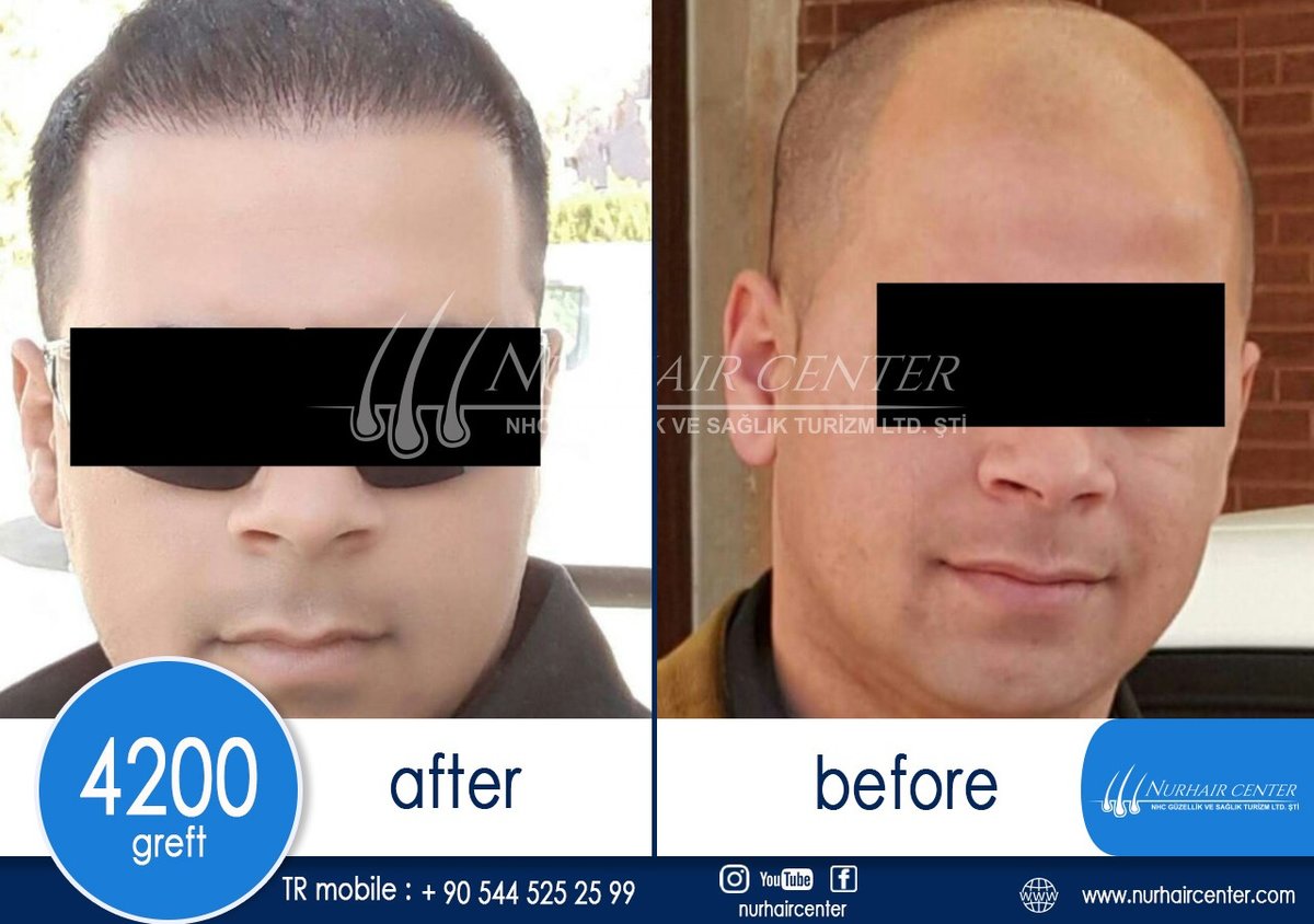 Nur Hair Center - Nur Hair Center