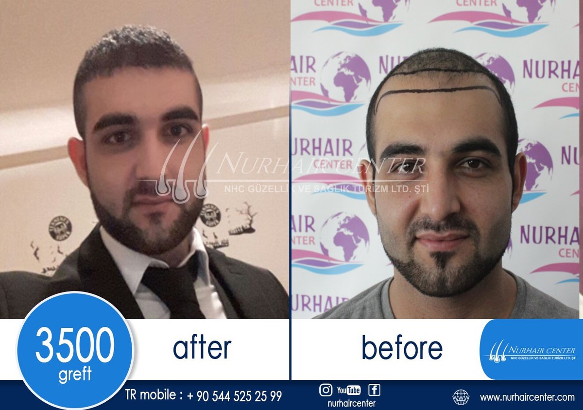 Nur Hair Center - Nur Hair Center