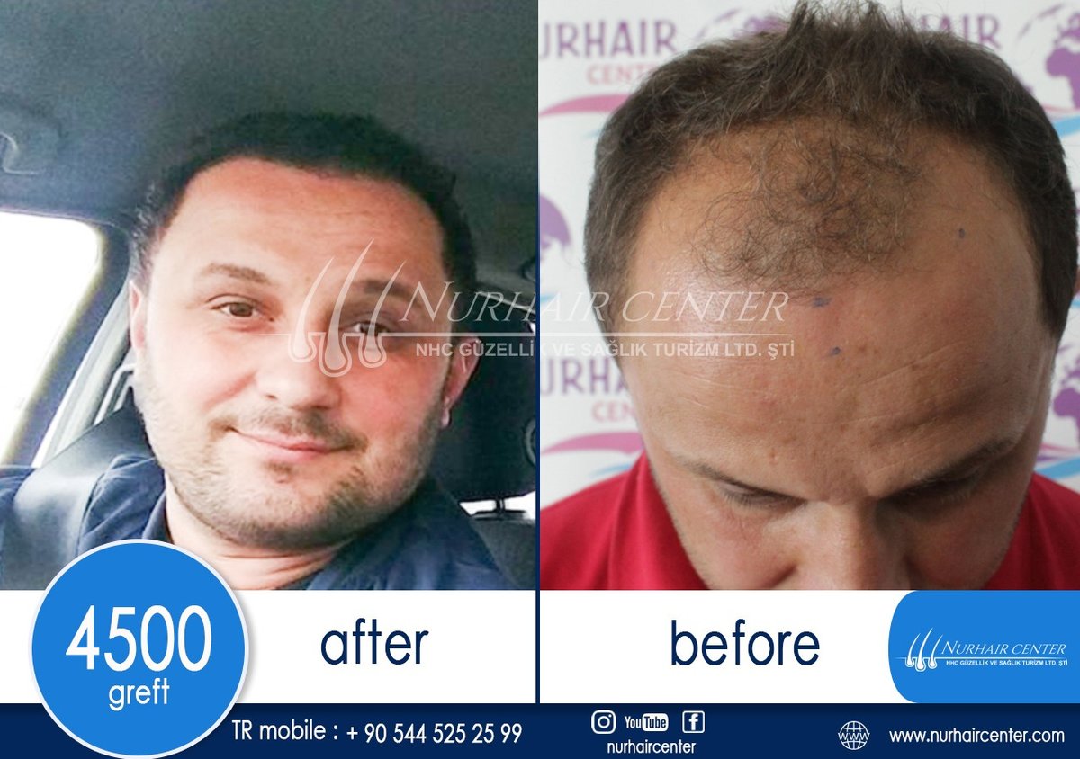 Nur Hair Center - Nur Hair Center