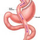 حلول السمنة والسمنة - Obesity Bariatric Solutions