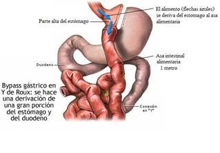 جراحي السمنة المكسيك - ميغيل أليمان - Obesity Surgeons México - Miguel Alemán