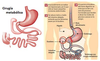 جراحي السمنة المكسيك - ميغيل أليمان - Obesity Surgeons México - Miguel Alemán