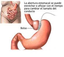 جراحي السمنة المكسيك - ميغيل أليمان - Obesity Surgeons México - Miguel Alemán