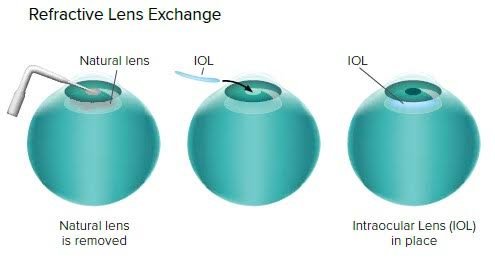 Optegra Eye Health Care Birmingham - Optegra Eye Health Care Birmingham