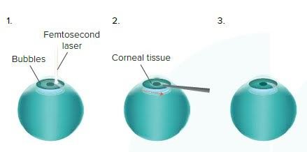 Optegra Eye Health Care Birmingham - Optegra Eye Health Care Birmingham
