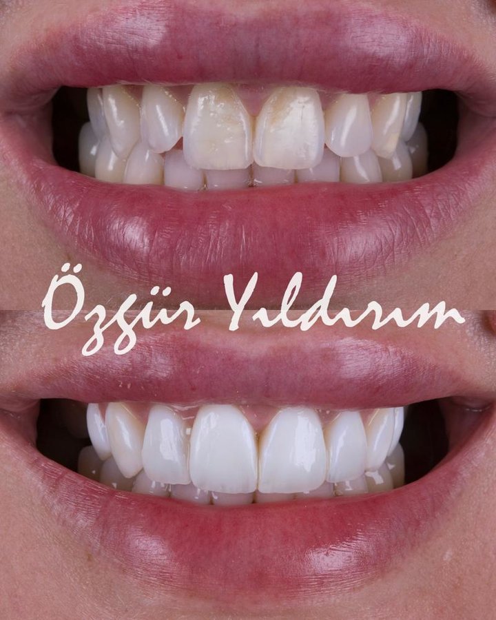 عيادة أوزغور يلدريم للأسنان التجميلية - Özgür Yıldırım Aesthetic Dental Clinic