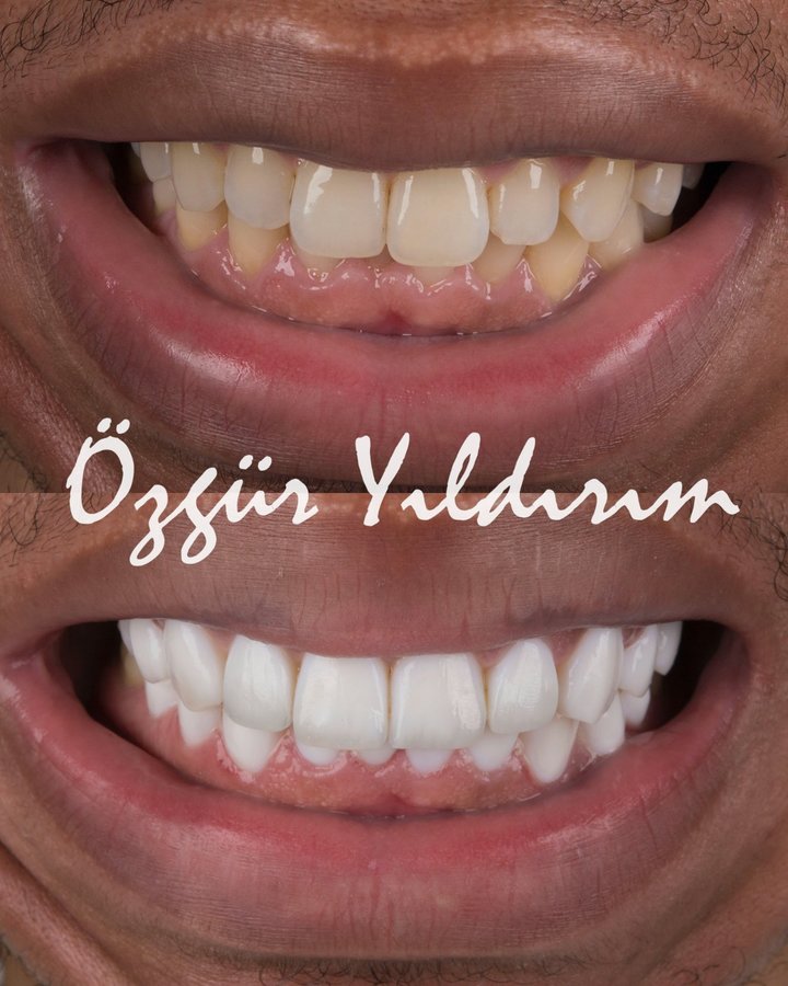 عيادة أوزغور يلدريم للأسنان التجميلية - Özgür Yıldırım Aesthetic Dental Clinic