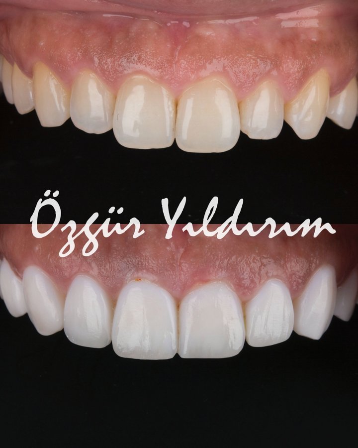 عيادة أوزغور يلدريم للأسنان التجميلية - Özgür Yıldırım Aesthetic Dental Clinic