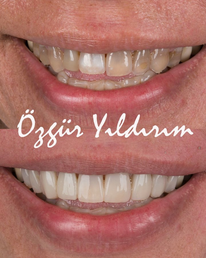 عيادة أوزغور يلدريم للأسنان التجميلية - Özgür Yıldırım Aesthetic Dental Clinic