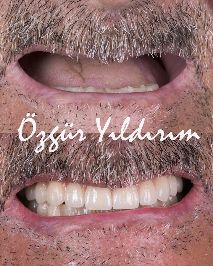عيادة أوزغور يلدريم للأسنان التجميلية - Özgür Yıldırım Aesthetic Dental Clinic