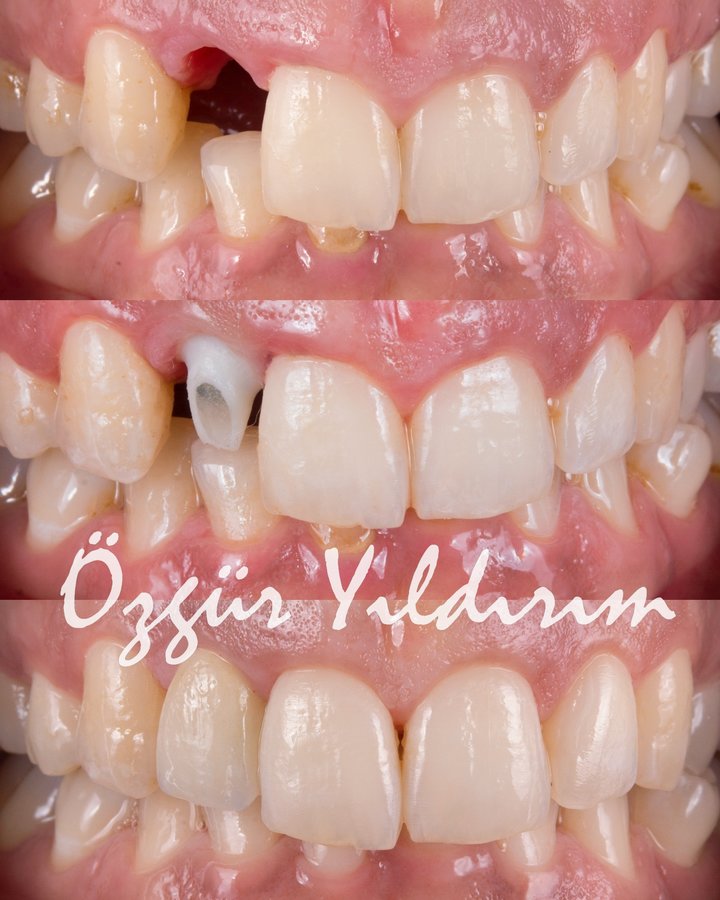 عيادة أوزغور يلدريم للأسنان التجميلية - Özgür Yıldırım Aesthetic Dental Clinic