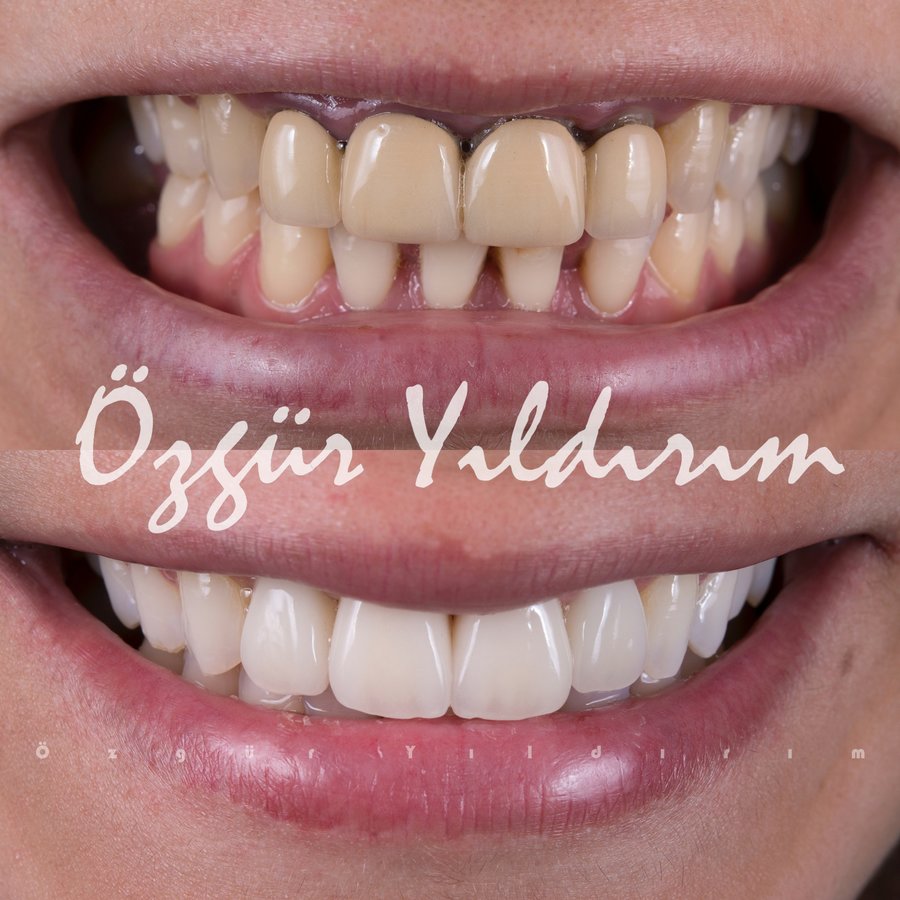عيادة أوزغور يلدريم للأسنان التجميلية - Özgür Yıldırım Aesthetic Dental Clinic