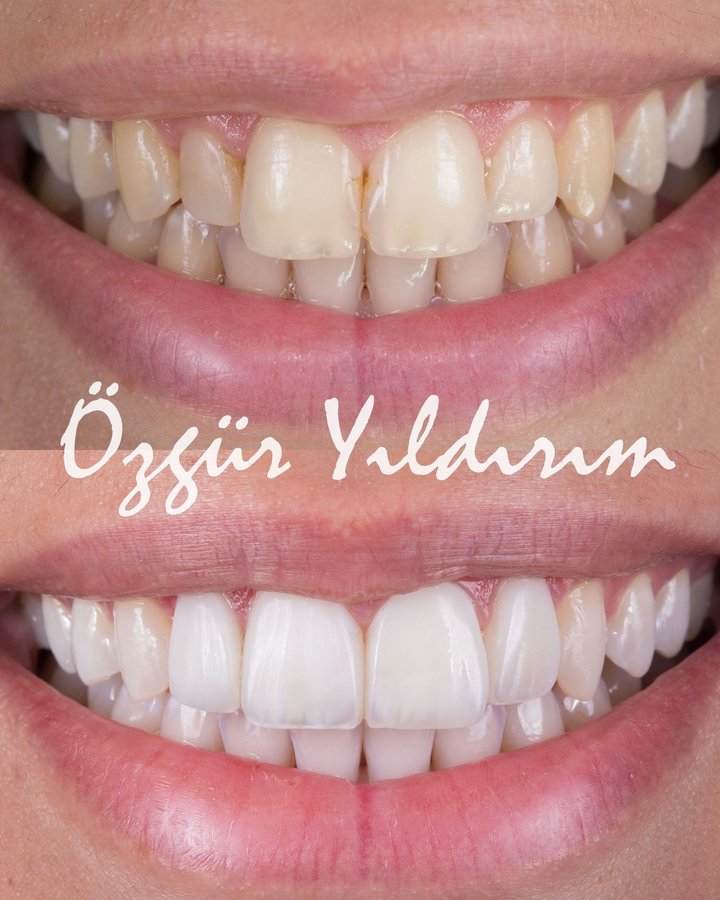 عيادة أوزغور يلدريم للأسنان التجميلية - Özgür Yıldırım Aesthetic Dental Clinic