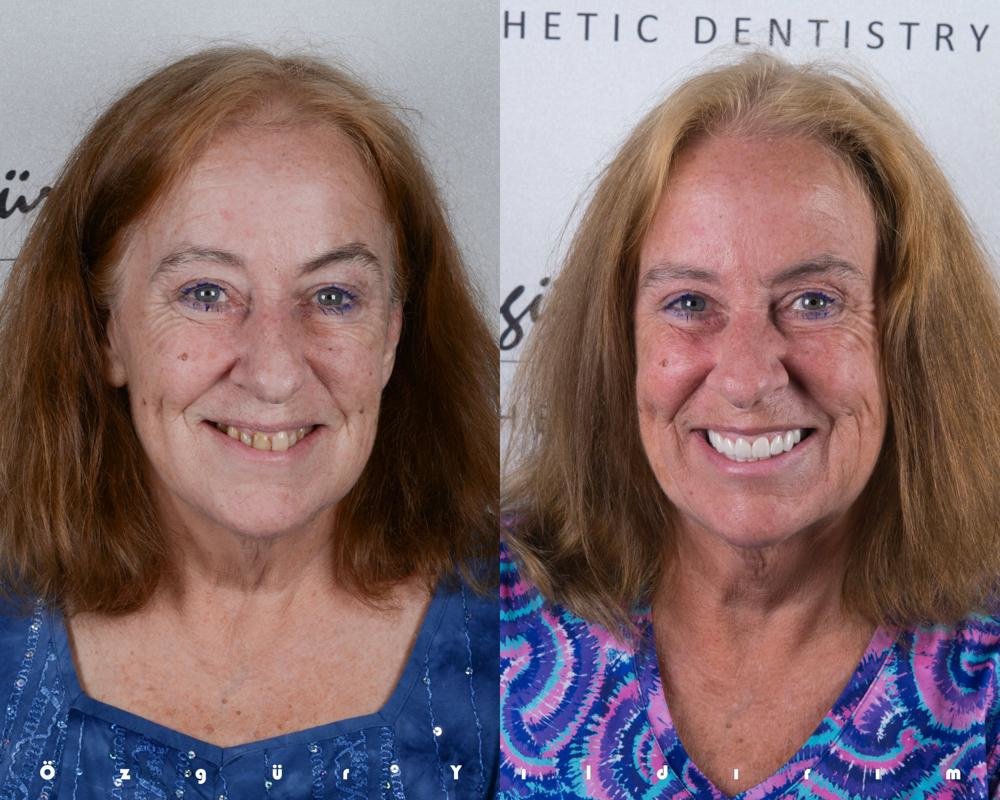 عيادة أوزغور يلدريم للأسنان التجميلية - Özgür Yıldırım Aesthetic Dental Clinic