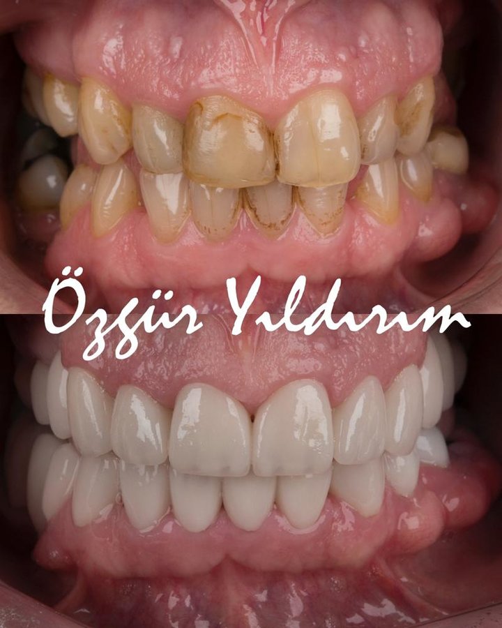 عيادة أوزغور يلدريم للأسنان التجميلية - Özgür Yıldırım Aesthetic Dental Clinic