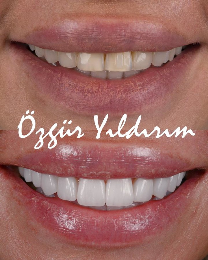 عيادة أوزغور يلدريم للأسنان التجميلية - Özgür Yıldırım Aesthetic Dental Clinic