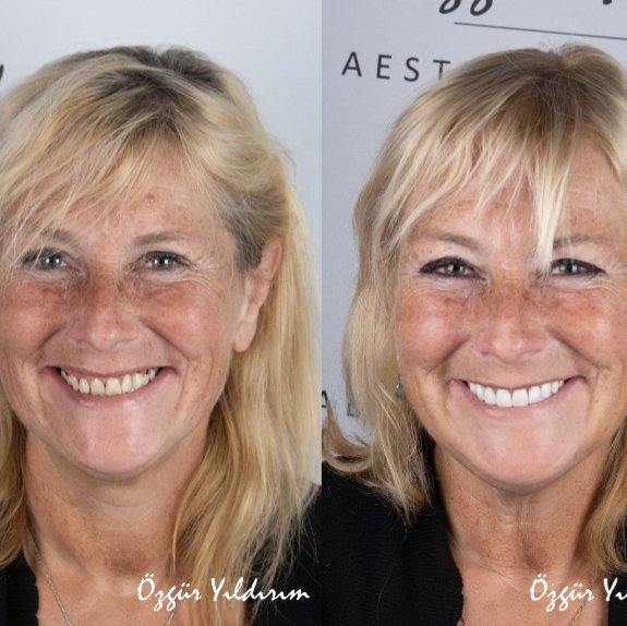 عيادة أوزغور يلدريم للأسنان التجميلية - Özgür Yıldırım Aesthetic Dental Clinic