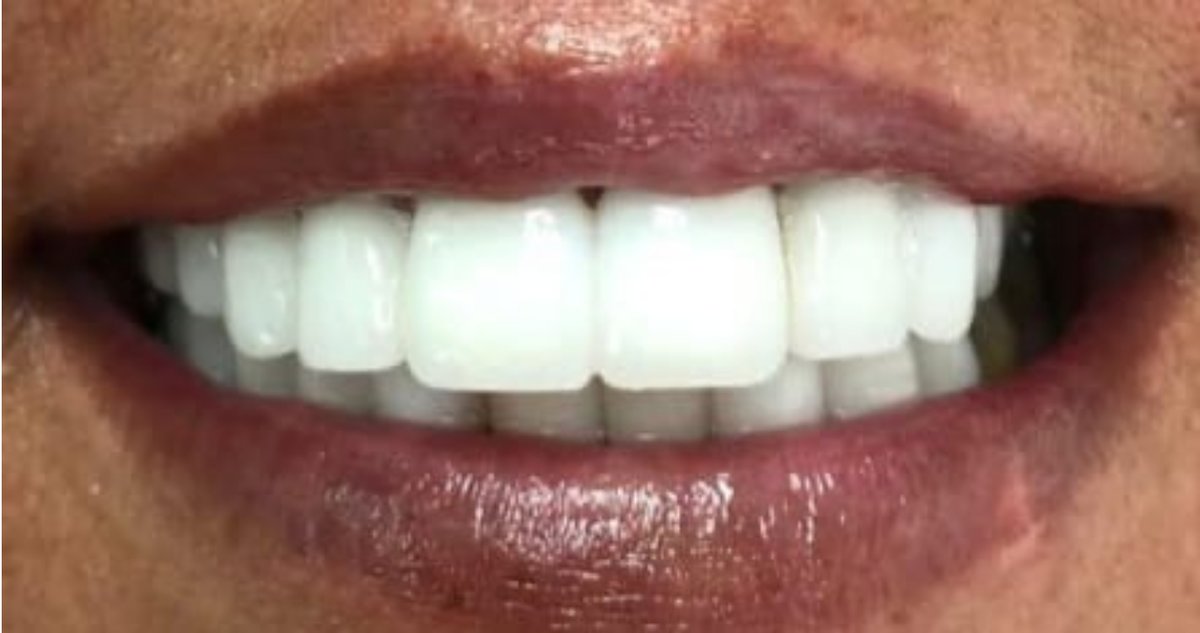 ابتسامة مثالية عيادة الأسنان مرمريس - Perfect Smile Dental Clinic Marmaris