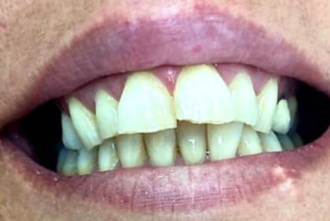 ابتسامة مثالية عيادة الأسنان مرمريس - Perfect Smile Dental Clinic Marmaris