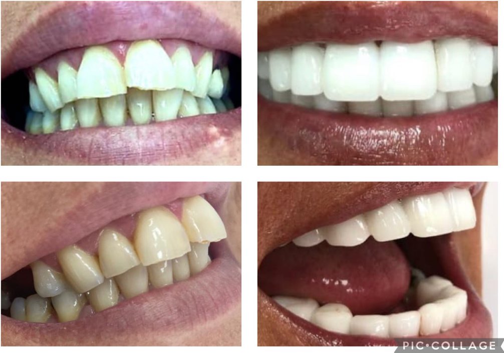 ابتسامة مثالية عيادة الأسنان مرمريس - Perfect Smile Dental Clinic Marmaris
