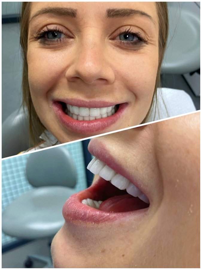 ابتسامة مثالية عيادة الأسنان مرمريس - Perfect Smile Dental Clinic Marmaris