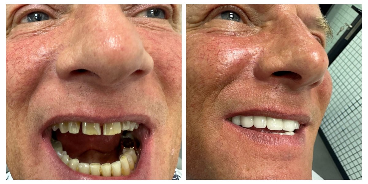 ابتسامة مثالية عيادة الأسنان مرمريس - Perfect Smile Dental Clinic Marmaris