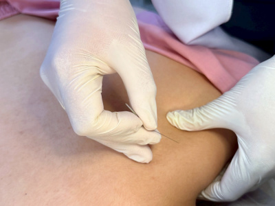 P.G. Clinic Pattaya คลินิกฝังเข็มพัทยาใต้ - Traditional Chinese Treatment in Progress