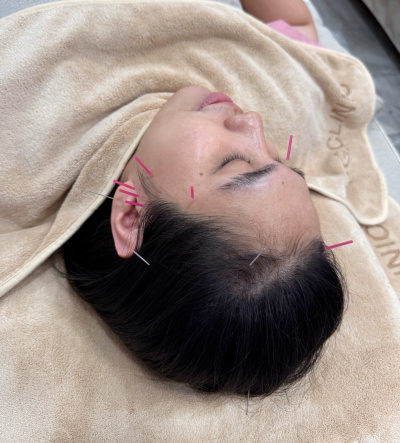 P.G. Clinic Pattaya คลินิกฝังเข็มพัทยาใต้ - Traditional Chinese Treatment in Progress