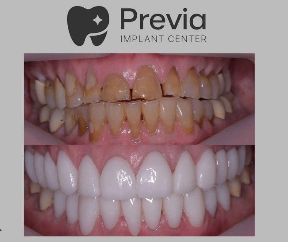Previa Implant Center - Previa Implant Center