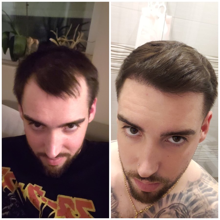 Pro Hair Transplant Clinic - Pro Hair Transplant Clinic