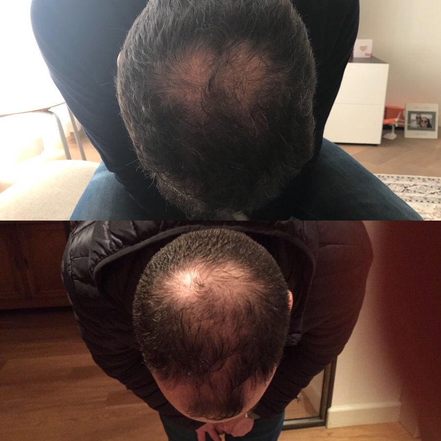 Pro Hair Transplant Clinic - Pro Hair Transplant Clinic